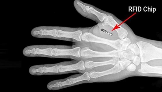 Вживленный RFID чип на рентгеновском снимке ладони руки